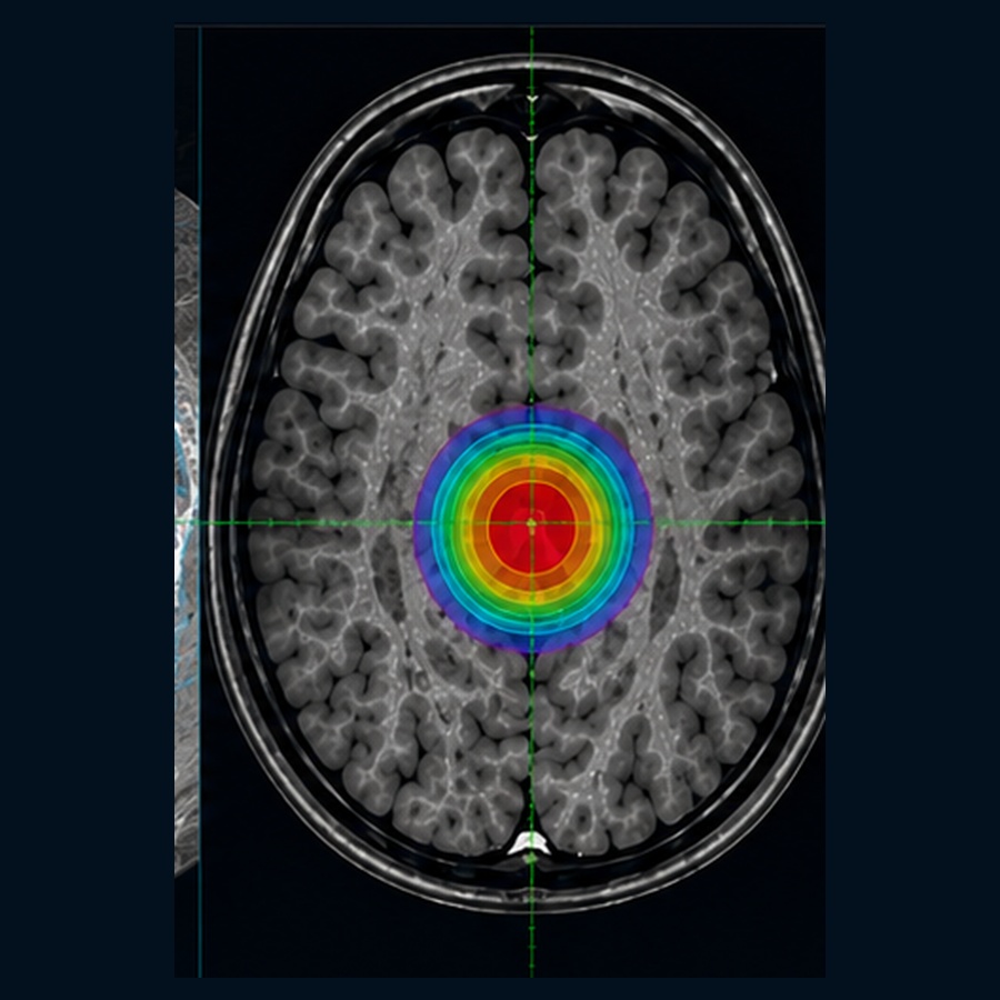 Brain SRS