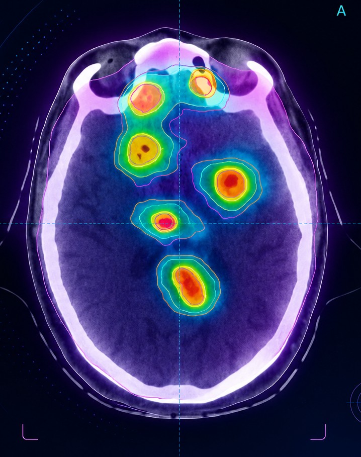 SRS-Behandlungsplanung multipler Hirnmetastasen mit Isodosen