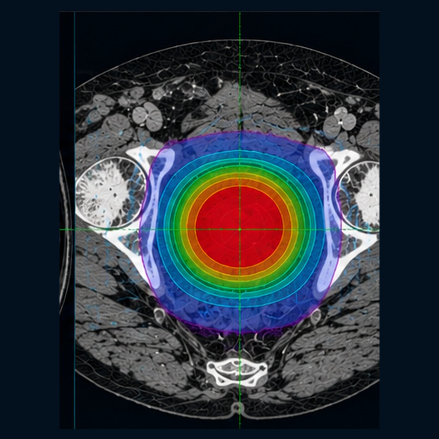 Pelvis SBRT